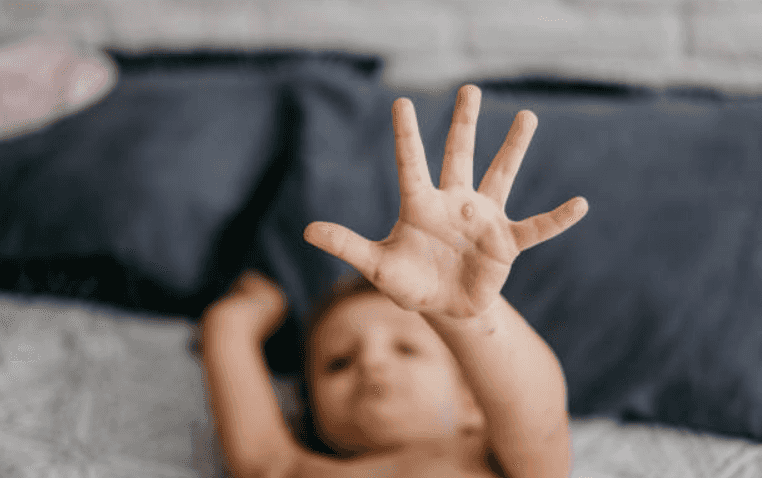 Parents in New York are holding ‘measles parties’ to expose unvaccinated kids