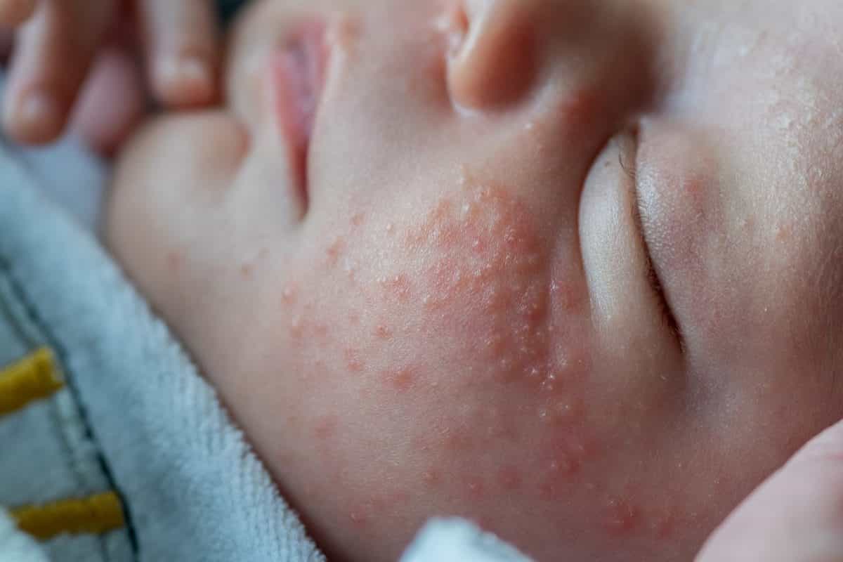 From eczema to nappy rash, baby’s skin is among the top parenting concerns